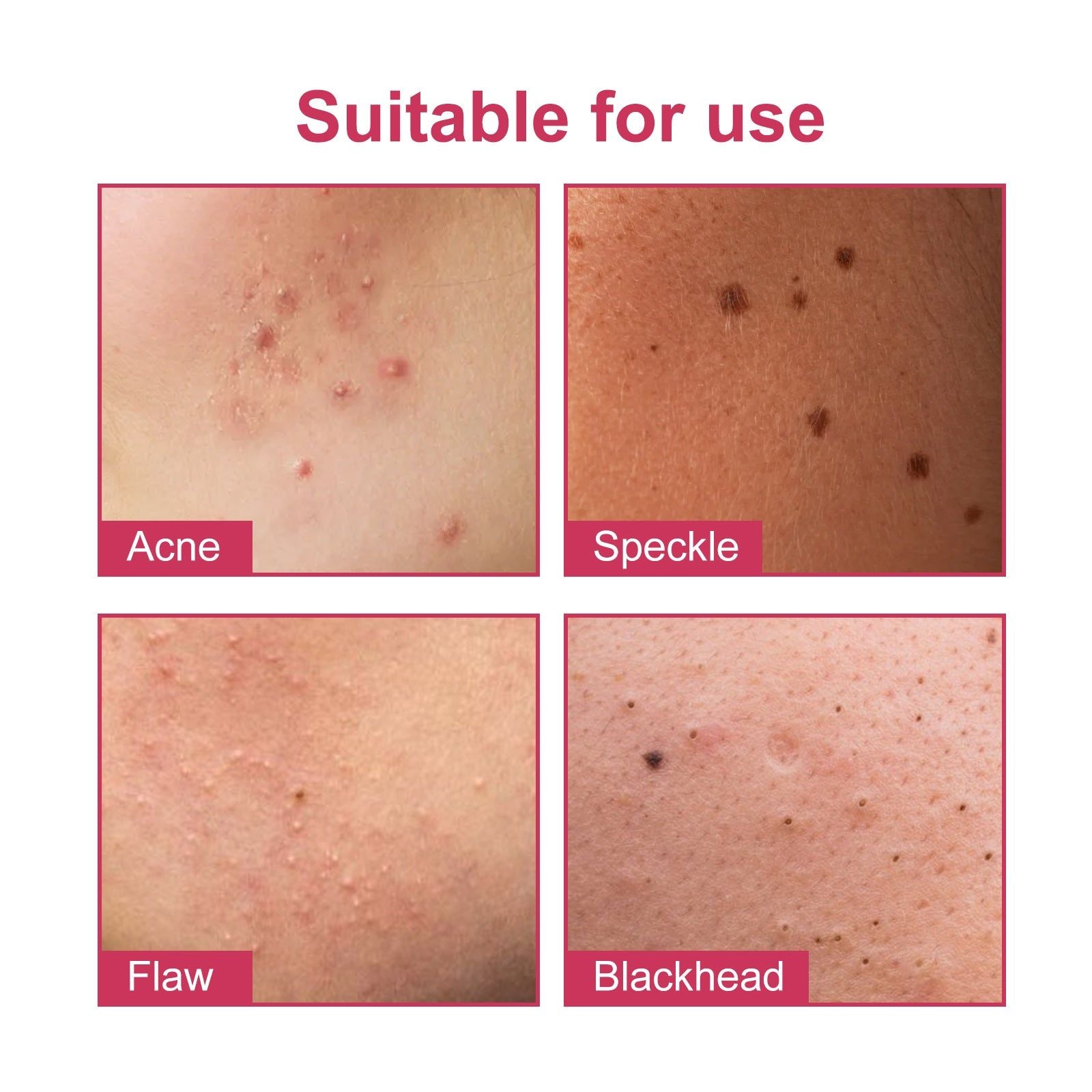 Clear Acne Marks Fast, Hydrating, Pimple Patches for Spot Healing, Acne Scar Treatment ,144pcs