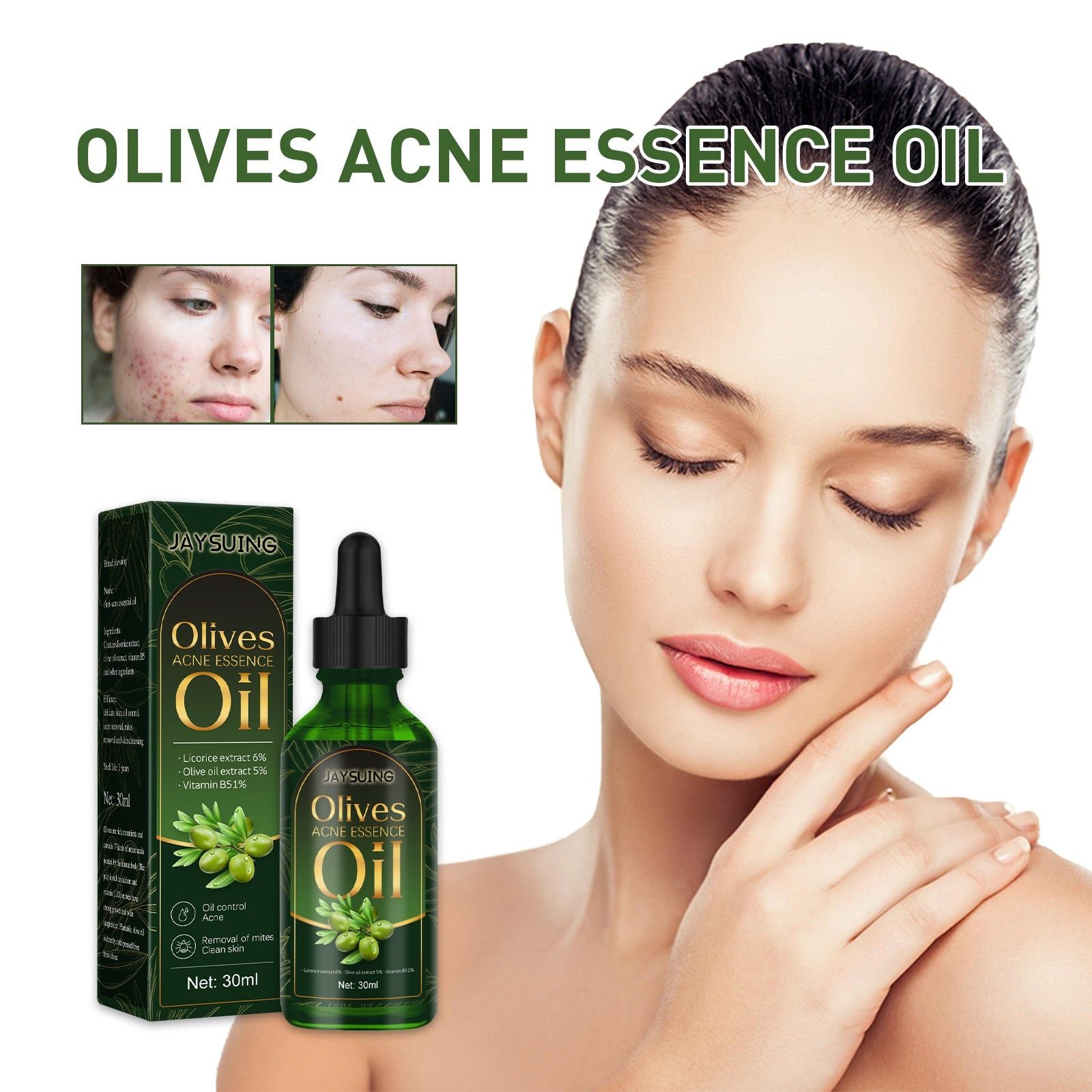 Acne Essential Oil, Remove Mites, Moisturize, Fade Red, Clear Skin ,30ml