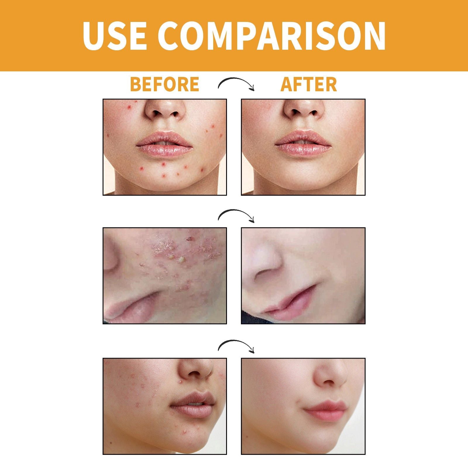 Chin Acne Patch, Smoothing Pimple & Oil Absorbing Hydrocolloidal Mask ,10pcs