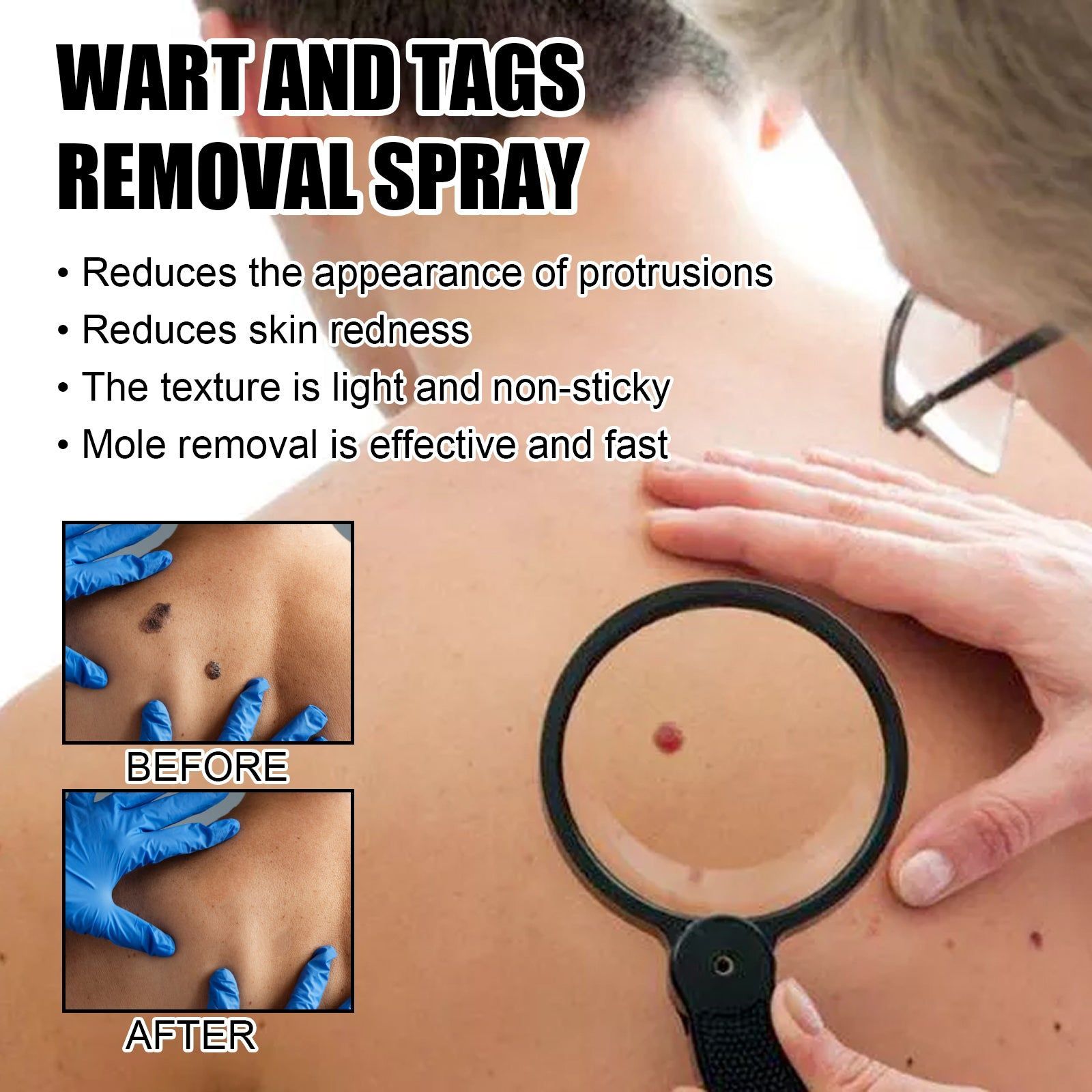 Bee Venom Wart Care Spray, Gentle Skin Tightening, Fast Mole Removal ,20ml