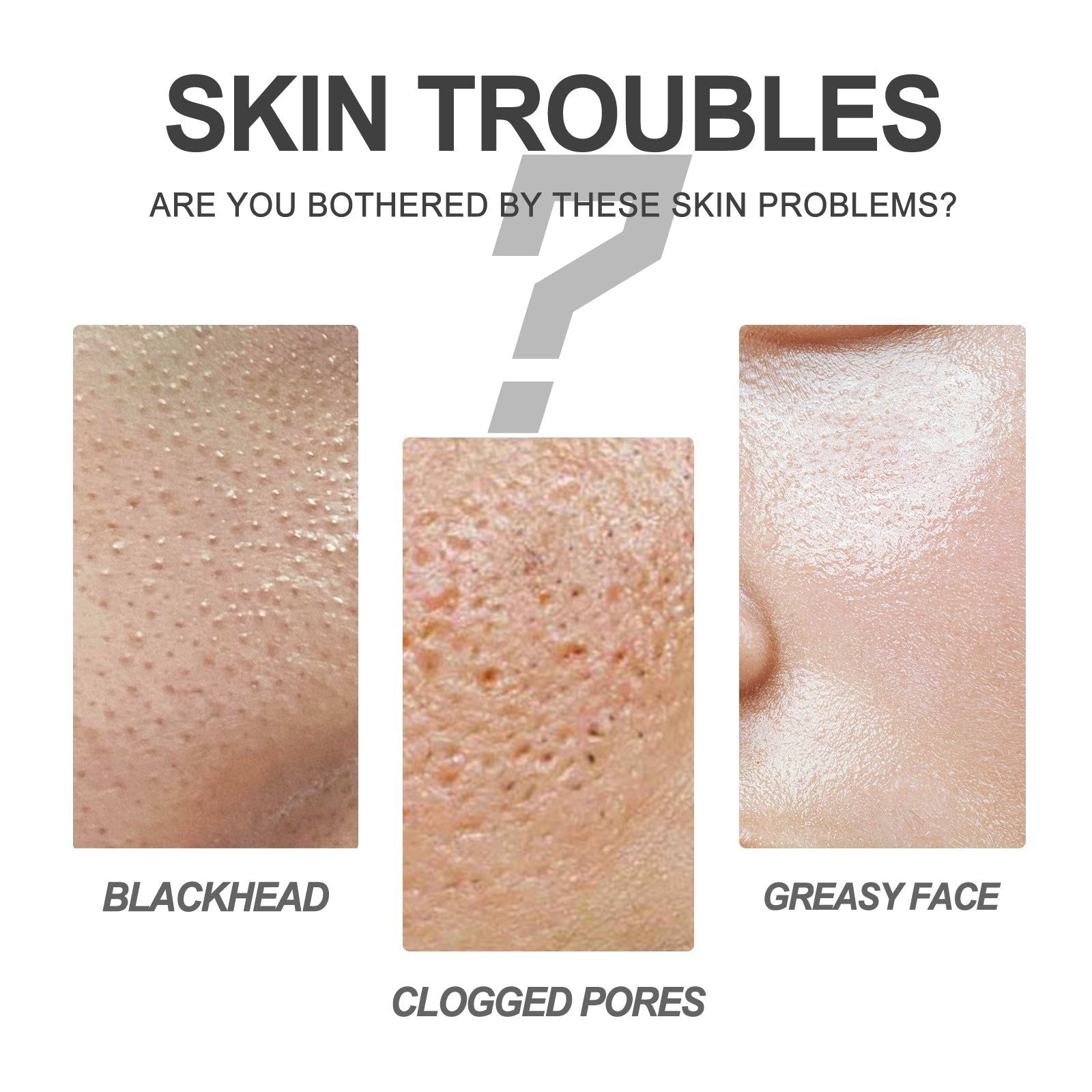 Clear Blackheads and Clean Skin, Pore Tightening, Acne Exfoliating Cream ,1set