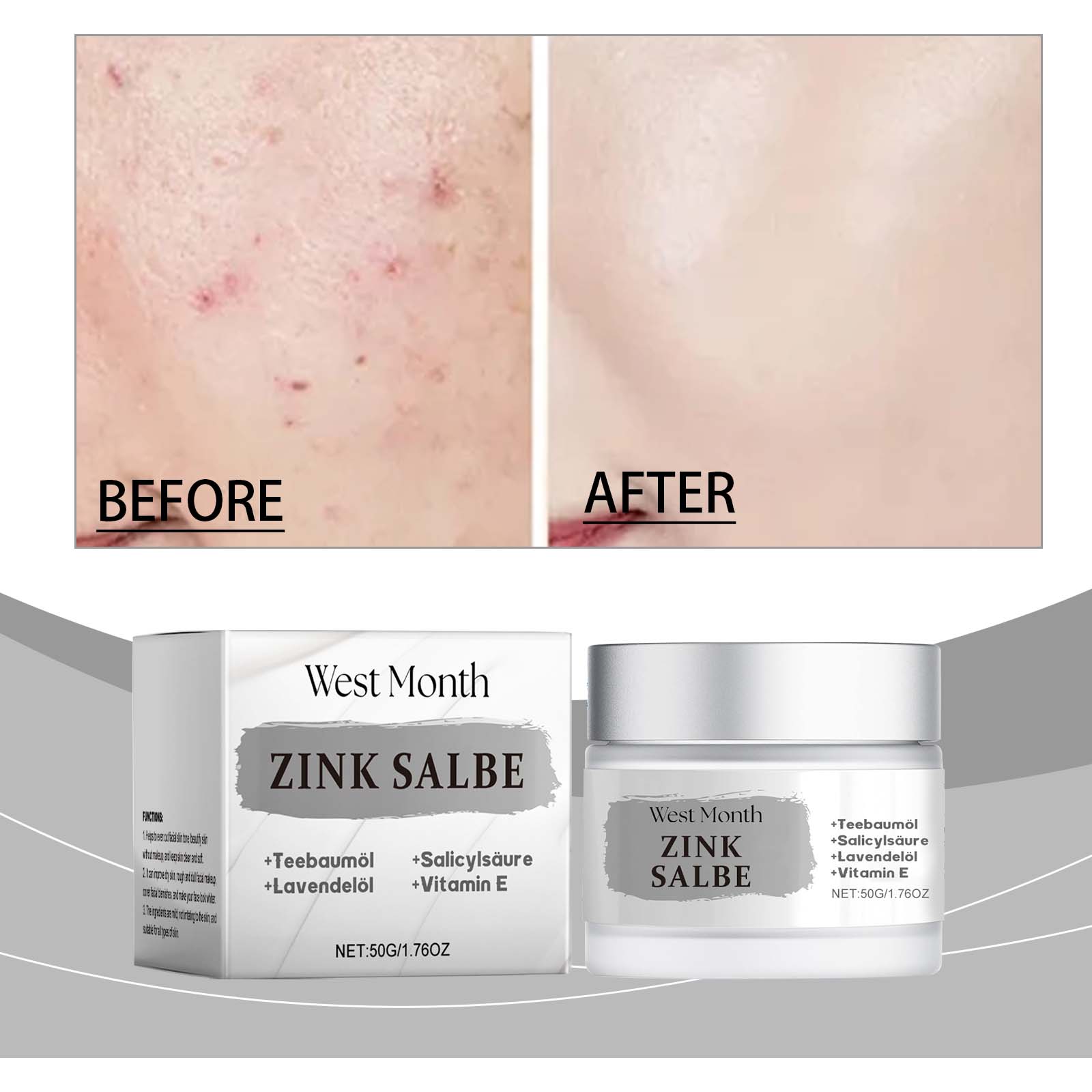 Acne Face Cream, Oil Control, Soothing, Poreless, Gentle Facial Care ,50g