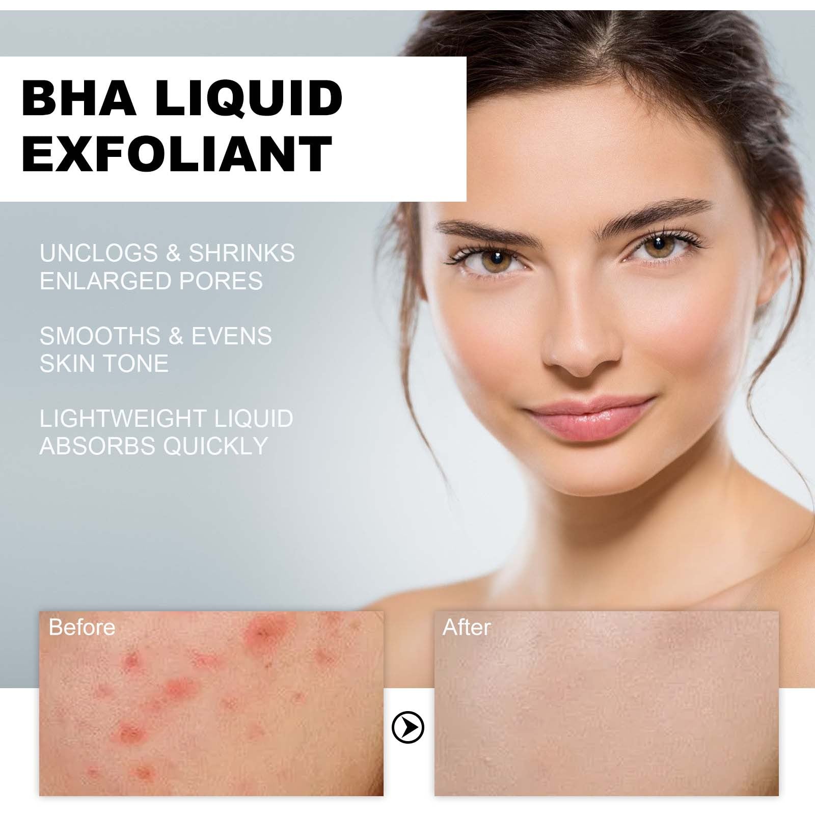 Salicylic Acid Acne Serum, BHA Liquid Exfoliant, Pore Tightening, Clear Skin, Moisturizing ,118ml