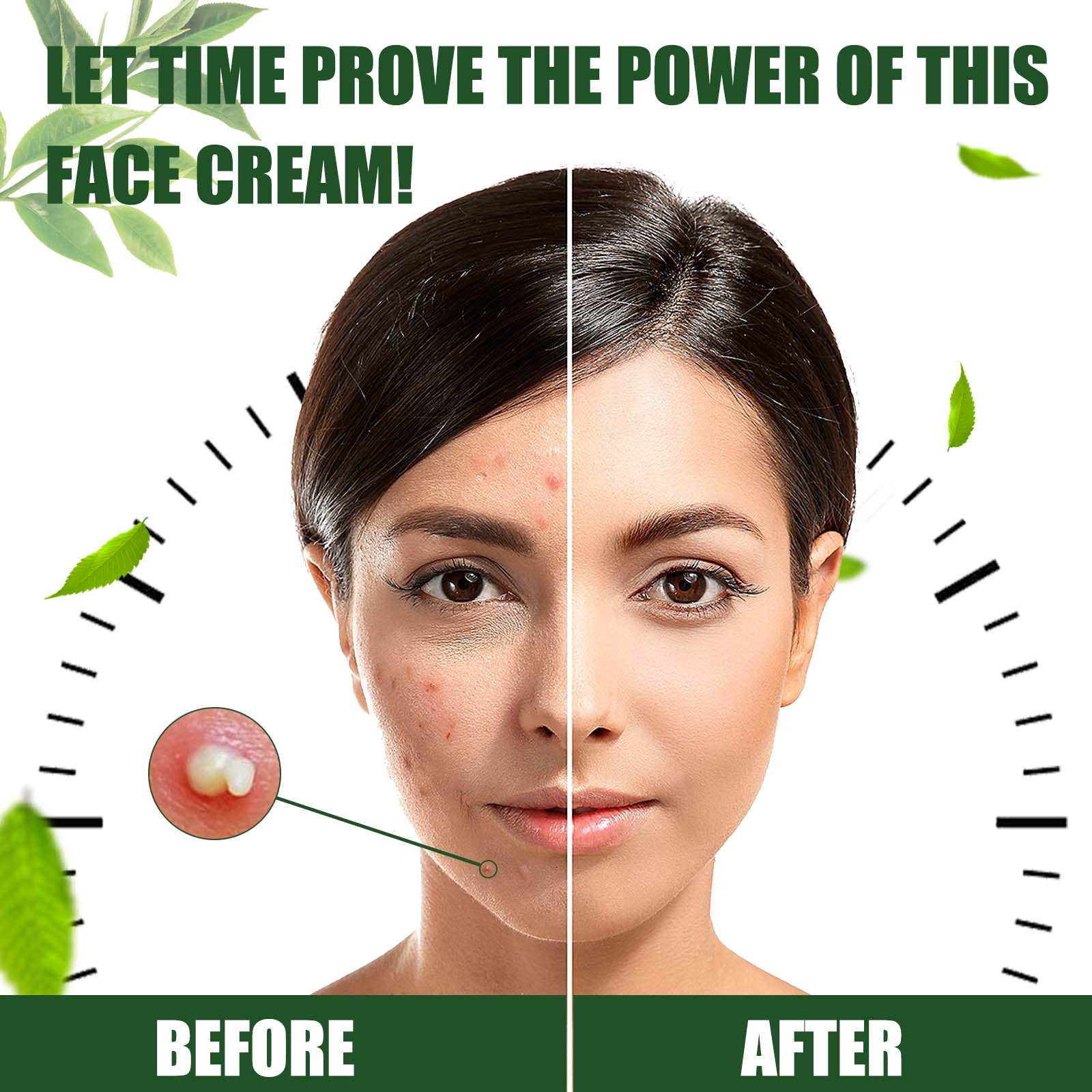 Clear Acne Scar Repair Cream, Salicylic Acid, Vitamin E, Pimple Treatment, Suitable for Facial Skin ,30g