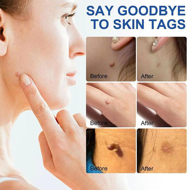 Auto Skin Tags Removal Tool Device with Cleansing Wipes - Safe, Painless Skin Tag Remover Kit